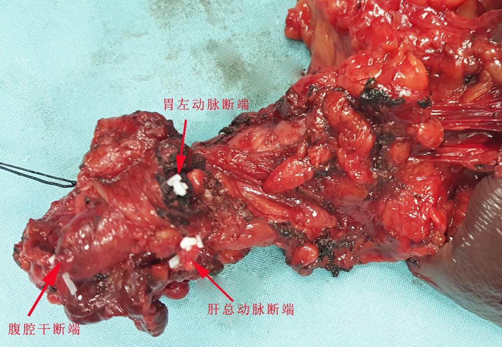 胰体尾癌图片